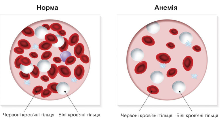 Анемія: Коли Крові Не Вистачає… Чи Вистачає Сили?